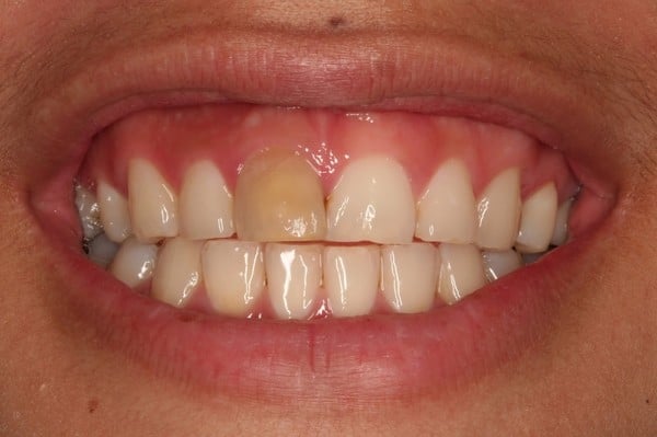 Отбеливание "мертвых" зубов: методики, процесс, диагностика